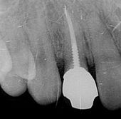 インプラント　症例　歯肉弁根尖即位道術