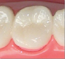 奥歯のジルコニア、 セラミッククラウン画像