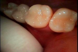 治療後　セラミックインレー