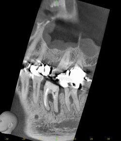 CT 根尖病巣 ブログ 　1